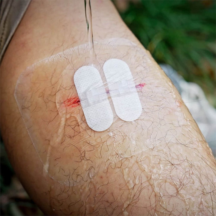 Advanced Wound Closure Kit - FlareSyn