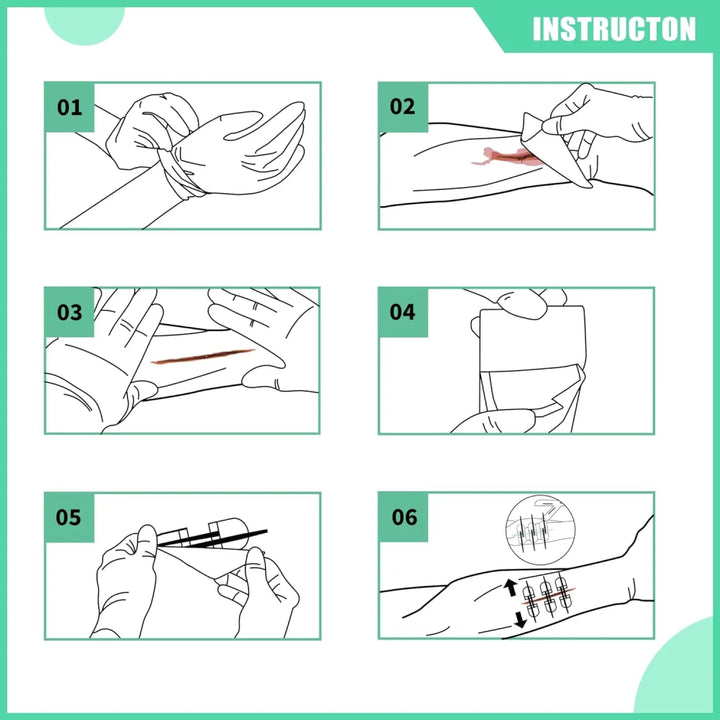 Advanced Wound Closure Kit - FlareSyn